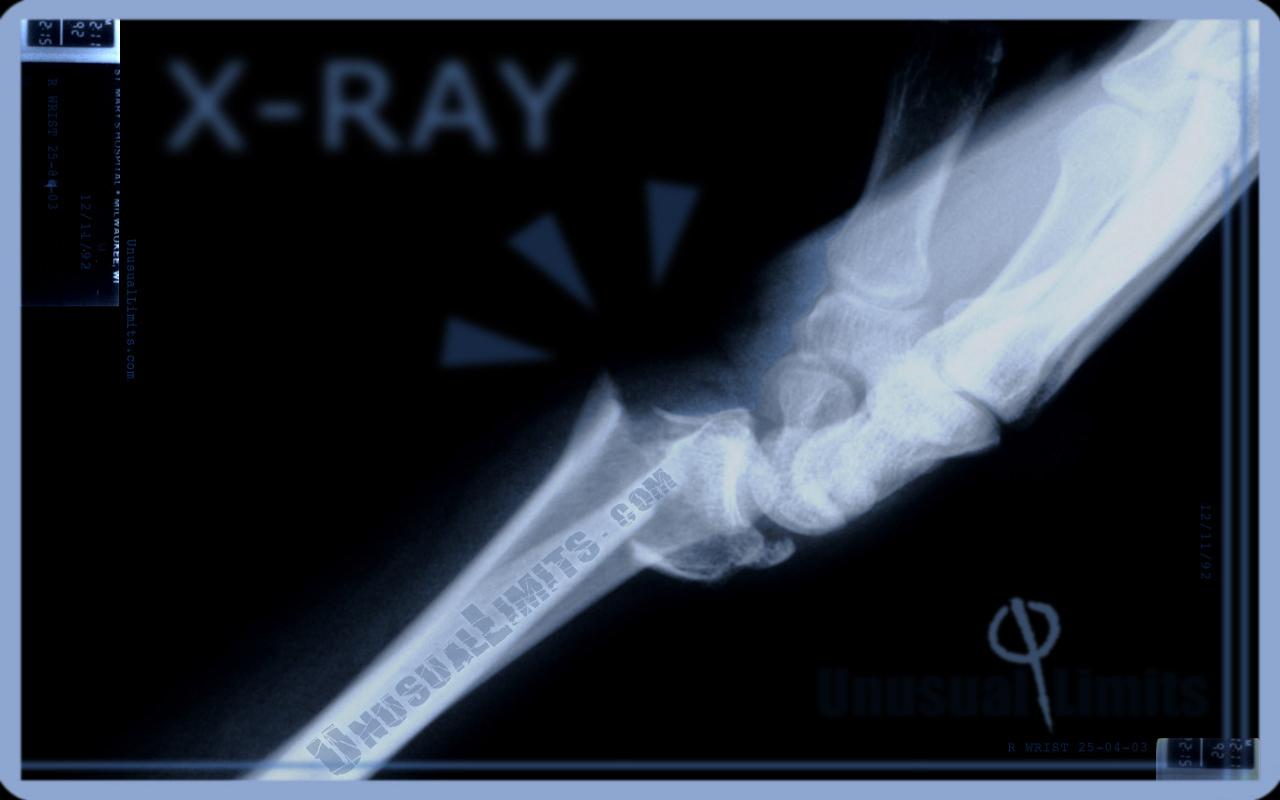 Unusual Limits X-ray